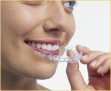 Step 1 - Invisalign