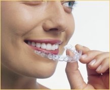 Step 1 - Invisalign