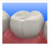 Composite and Tooth Color Fillings, Cosmetic tooth fillings